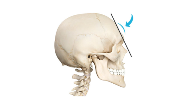Eyebrow Bone Resection